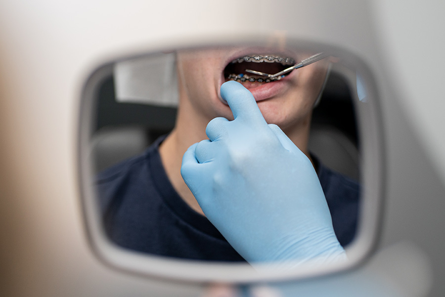 Resultaat orthodontische correctie